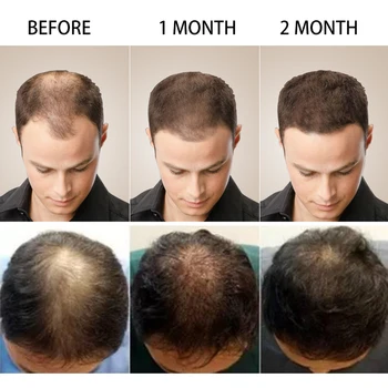  5 Zile De Ghimbir Creșterea Părului Produse Naturale Anti Caderea Parului Preveni Chelie Tratament Cu Creștere Rapidă Hranesc Uscat Deteriorat De Îngrijire A Părului